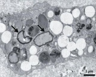 頸動脈の塊から微小プラ　脳卒中４倍、伊の研究チーム発表