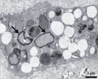 頸動脈の塊から微小プラ　脳卒中4倍、伊の研究チーム発表