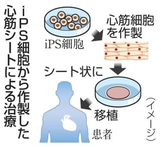 「心筋シート」承認申請へ　阪大開発、ベンチャー企業