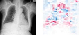 ＡＩで画像から肺機能推定　胸部エックス線、診断活用
