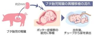 ブタ腎臓の重症胎児への移植申請　慈恵医大、実現すれば国内初