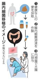 腸内細菌移植の研究開始　パーキンソン病患者に、順天堂大